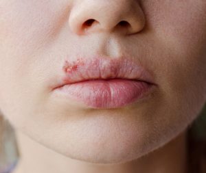 L'herpes labiale è un esempio di correlazione tra emozioni e sistema immunitario